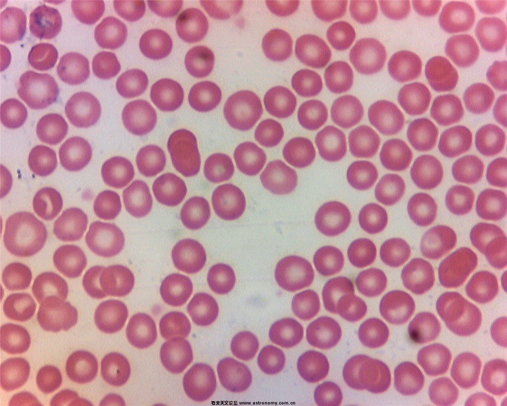 白血病患者血液涂片的显微镜观察照片摄影图片_ID:166180634-Veer图库