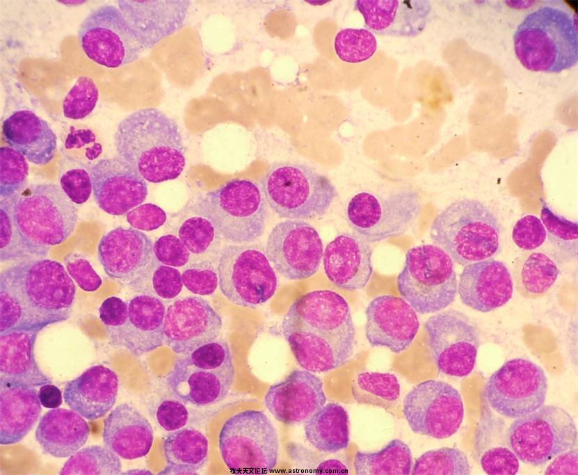 浆细胞瘤2.jpg